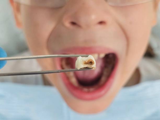 Best Dental Abscess Treatment in Meadowbrook, VA